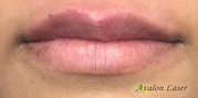 Lip Augmentation Before & After Gallery - Patient 20494384 - Image 2