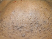 Laser Hair Removal Before & After Gallery - Patient 20490481 - Image 1