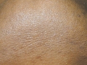 Laser Hair Removal Before & After Gallery - Patient 20490481 - Image 2