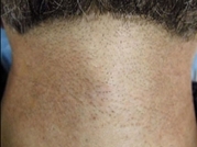 Laser Hair Removal Before & After Gallery - Patient 20490482 - Image 1
