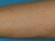 Laser Hair Removal Before & After Gallery - Patient 20490483 - Image 2
