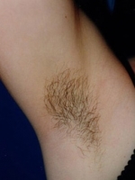 Laser Hair Removal Before & After Gallery - Patient 20490484 - Image 1