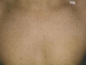 Laser Hair Removal Before & After Gallery - Patient 20491023 - Image 2