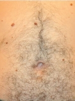 Laser Hair Removal Before & After Gallery - Patient 20491024 - Image 1