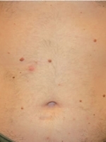 Laser Hair Removal Before & After Gallery - Patient 20491024 - Image 2
