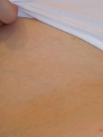 Laser Hair Removal Before & After Gallery - Patient 20491025 - Image 2
