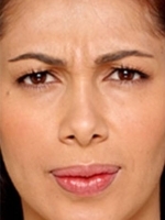 Botox Before & After Gallery - Patient 20492644 - Image 1