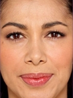 Botox Before & After Gallery - Patient 20492644 - Image 2