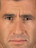 Botox Before & After Gallery - Patient 20492646 - Image 1