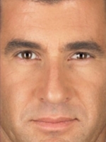 Botox Before & After Gallery - Patient 20492646 - Image 2