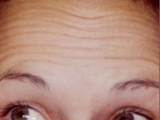 Botox Before & After Gallery - Patient 20492647 - Image 1