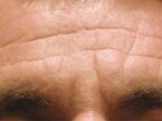 Botox Before & After Gallery - Patient 20492648 - Image 1