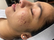 Facial Aesthetic Services Before & After Gallery - Patient 20493188 - Image 1