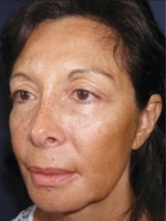 Facial Aesthetic Services Before & After Gallery - Patient 20493189 - Image 1