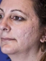 Scar Removal Before & After Gallery - Patient 20493190 - Image 1