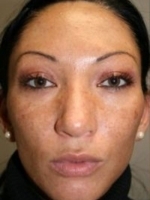 Facial Aesthetic Services Before & After Gallery - Patient 20493191 - Image 1