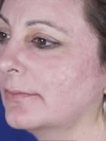 Scar Removal Before & After Gallery - Patient 20493190 - Image 2