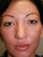 Facial Aesthetic Services Before & After Gallery - Patient 20493191 - Image 2