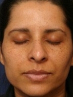 Facial Aesthetic Services Before & After Gallery - Patient 20493193 - Image 1
