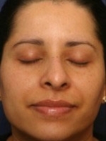 Facial Aesthetic Services Before & After Gallery - Patient 20493193 - Image 2