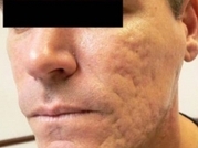 Scar Removal Before & After Gallery - Patient 20493194 - Image 1