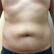 Body Sculpting Before & After Gallery - Patient 20493195 - Image 1