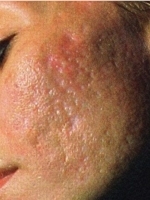 Scar Removal Before & After Gallery - Patient 20493196 - Image 1