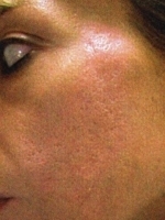 Scar Removal Before & After Gallery - Patient 20493196 - Image 2