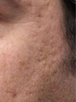 Scar Removal Before & After Gallery - Patient 20493198 - Image 1