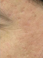 Scar Removal Before & After Gallery - Patient 20493198 - Image 2