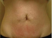Body Sculpting Before & After Gallery - Patient 20493199 - Image 2