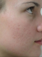 Scar Removal Before & After Gallery - Patient 20493202 - Image 2