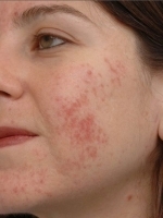 Scar Removal Before & After Gallery - Patient 20493203 - Image 1