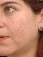 Scar Removal Before & After Gallery - Patient 20493203 - Image 2
