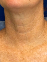 Vivace RF Microneedling Before & After Gallery - Patient 20493204 - Image 1