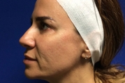 Vivace RF Microneedling Before & After Gallery - Patient 20493205 - Image 1