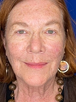 Facial Laser Treatments Before & After Gallery - Patient 20493207 - Image 2