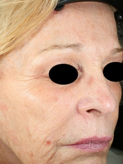 Vivace RF Microneedling Before & After Gallery - Patient 20493208 - Image 1