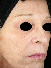 Vivace RF Microneedling Before & After Gallery - Patient 20493208 - Image 2