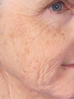 Facial Laser Treatments Before & After Gallery - Patient 20493210 - Image 1