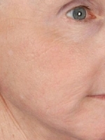 Facial Laser Treatments Before & After Gallery - Patient 20493210 - Image 2