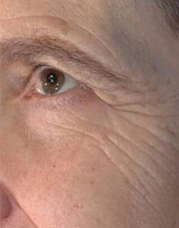 Vivace RF Microneedling Before & After Gallery - Patient 20493211 - Image 1