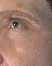 Vivace RF Microneedling Before & After Gallery - Patient 20493211 - Image 2