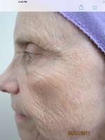 Facial Laser Treatments Before & After Gallery - Patient 20493212 - Image 1