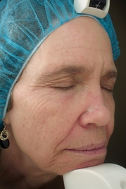 Vivace RF Microneedling Before & After Gallery - Patient 20493231 - Image 1