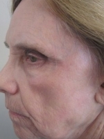 Facial Laser Treatments Before & After Gallery - Patient 20493212 - Image 2