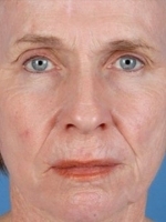 Facial Laser Treatments Before & After Gallery - Patient 20493232 - Image 2
