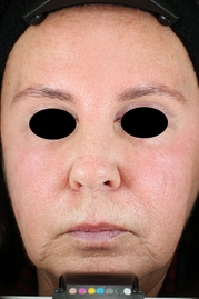 Vivace RF Microneedling Before & After Gallery - Patient 20493233 - Image 1