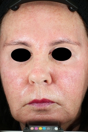 Vivace RF Microneedling Before & After Gallery - Patient 20493233 - Image 2