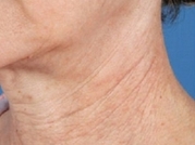 Facial Laser Treatments Before & After Gallery - Patient 20493234 - Image 1